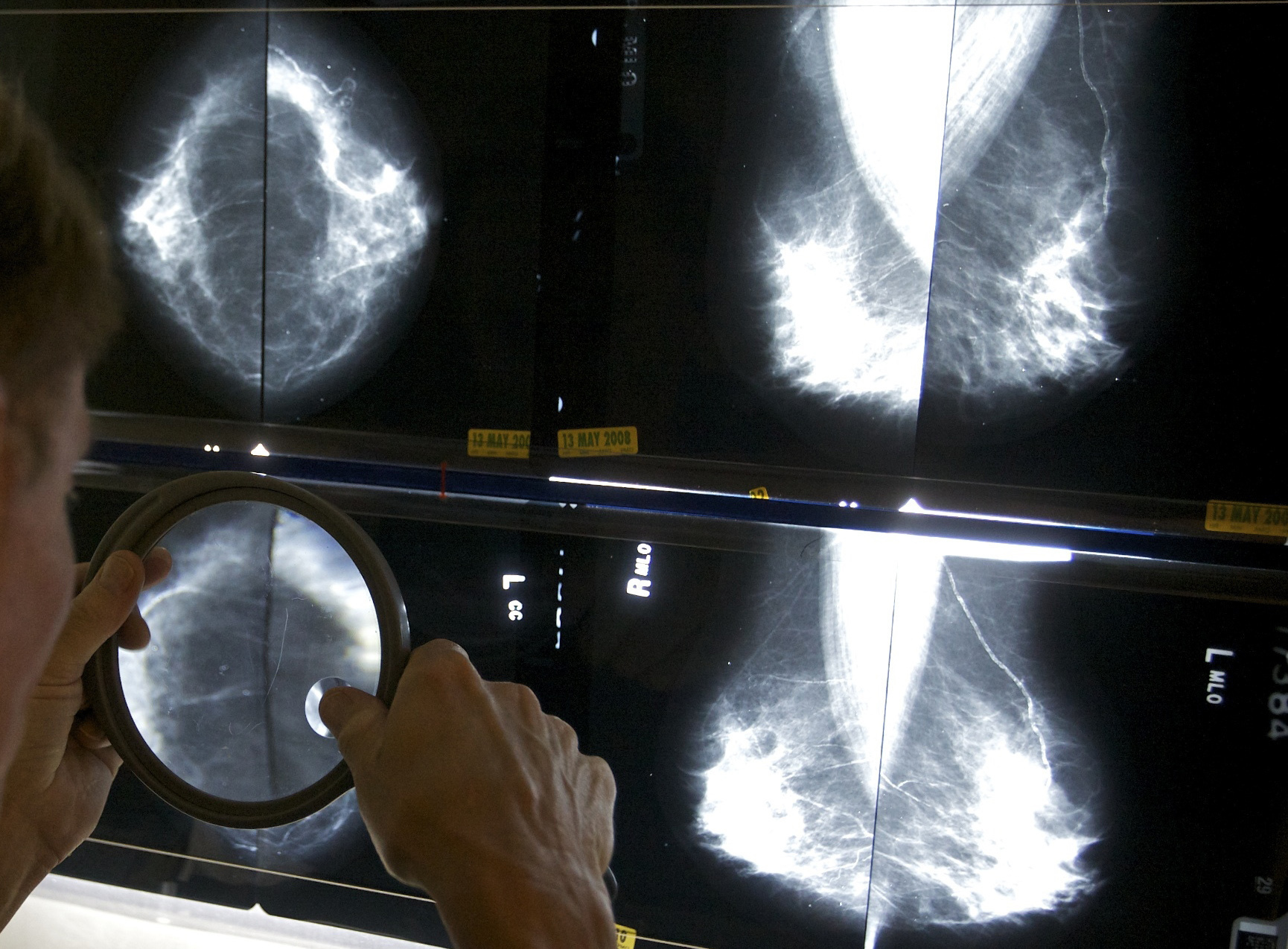 FILE - A radiologist uses a magnifying glass to check mammograms for breast cancer in Los Angeles, May 6, 2010. Annual mammograms are now recommended indefinitely for breast cancer survivors in many countries including the United States. Now a large British study finds that less frequent screening is just as good. The findings were being discussed Friday, Dec. 8, 2023 at the San Antonio Breast Cancer Symposium. (AP Photo/Damian Dovarganes, File)