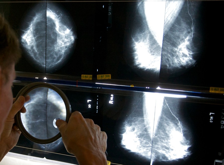 FILE - A radiologist uses a magnifying glass to check mammograms for breast cancer in Los Angeles, May 6, 2010. Annual mammograms are now recommended indefinitely for breast cancer survivors in many countries including the United States. Now a large British study finds that less frequent screening is just as good. The findings were being discussed Friday, Dec. 8, 2023 at the San Antonio Breast Cancer Symposium. (AP Photo/Damian Dovarganes, File)