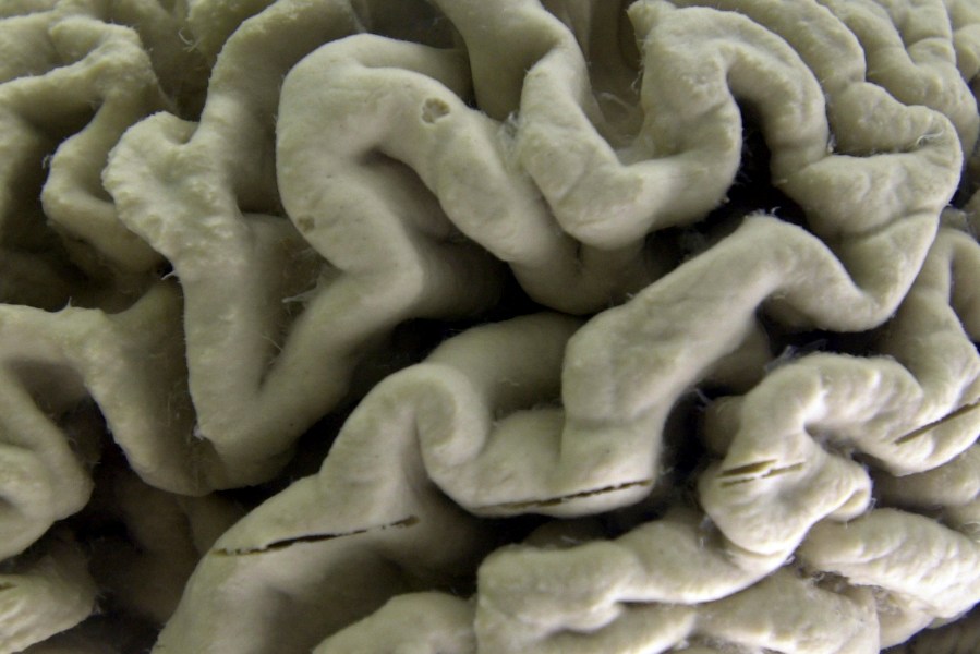 FILE - A section of a human brain with Alzheimer's disease is displayed at the Museum of Neuroanatomy at the University at Buffalo, in Buffalo, N.Y., Oct. 7, 2003. A long-feared gene appears to do more than raise people’s risk of Alzheimer’s: Inheriting two copies can cause the mind-robbing disease, according to research published in the journal Nature Medicine on Monday, May 6, 2024. (AP Photo/David Duprey, File)