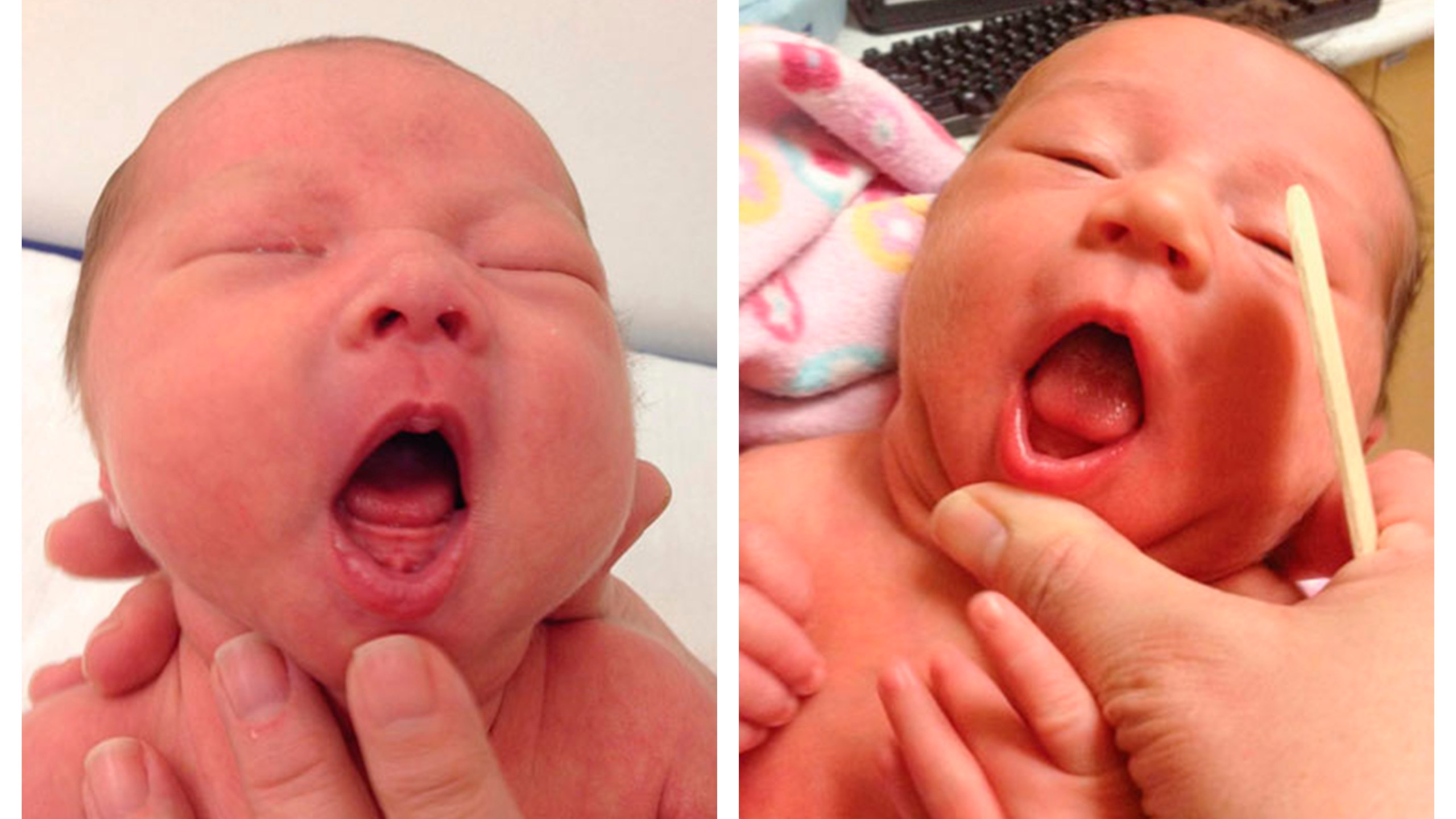 This combination of photos provided by Dr. Maya Bunik in July 2024, shows a baby with ankyloglossia where the tongue does not extend beyond the gums, left, and a baby with an indentation at the tip of a the tongue which may be a sign of ankyloglossia. On Monday, July 29, 2024, one of the largest doctor's groups in the U.S., voiced concerns that the condition, also known as "tongue-tie" which can affect breastfeeding, is being over-diagnosed and often treated with unnecessary surgery to babies' mouths. (Dr. Maya Bunik via AP)