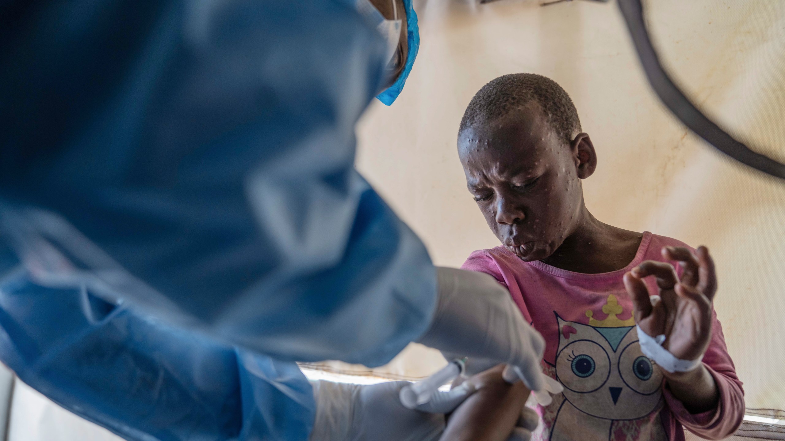 FILE - A health worker attends to an mpox patient, at a treatment center in Munigi, eastern Congo, Aug. 19, 2024. (AP Photo/Moses Sawasawa, File)