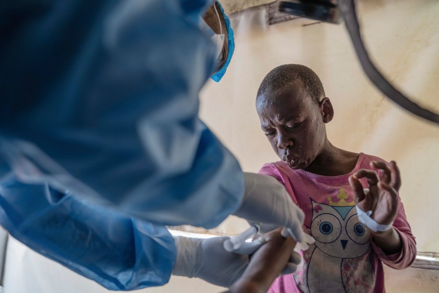 FILE - A health worker attends to an mpox patient, at a treatment center in Munigi, eastern Congo, Aug. 19, 2024. (AP Photo/Moses Sawasawa, File)