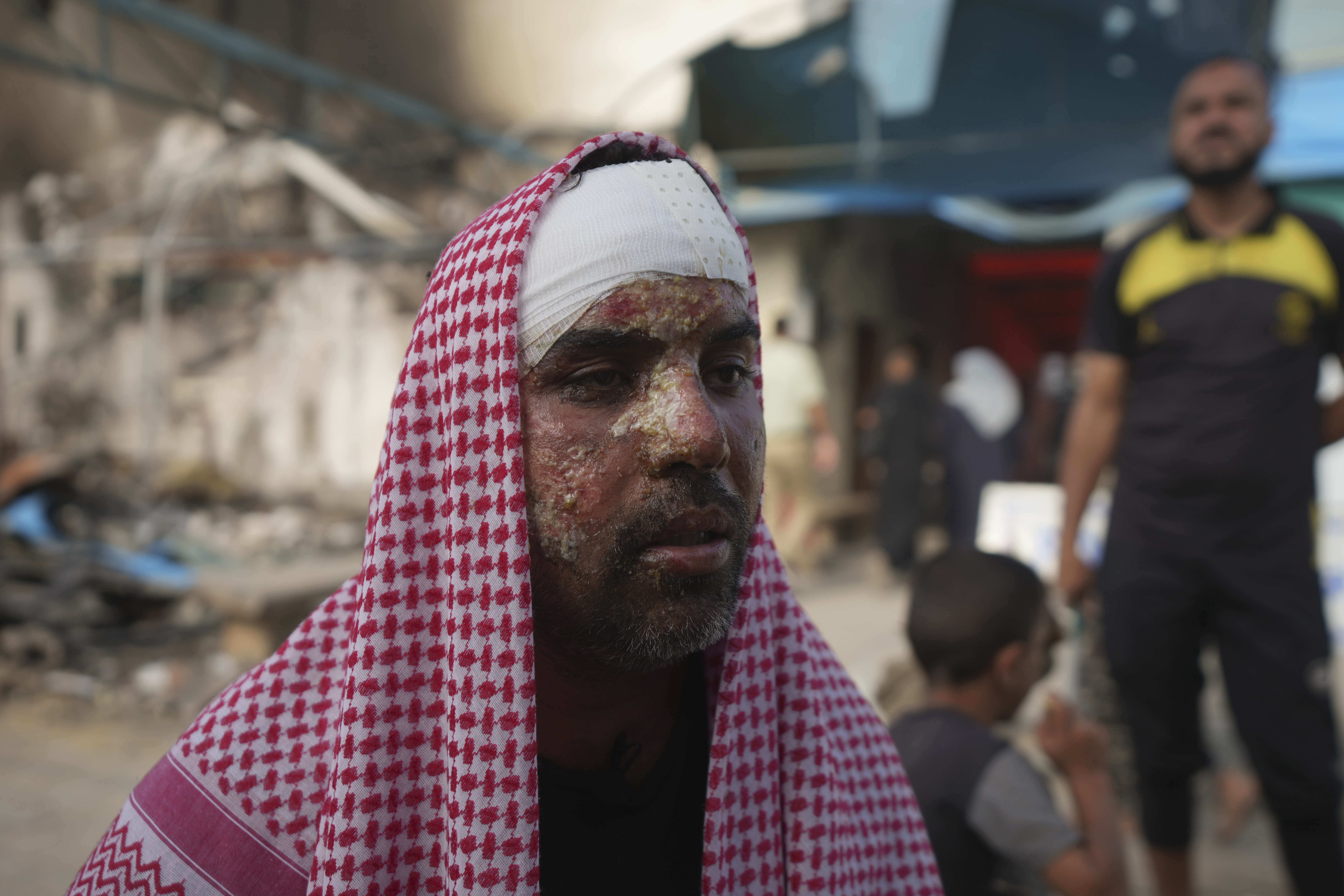 Ahmad al-Dalu, suffering from burns, lost his son, Shaban, in a fire after an Israeli strike hit a tent area in the courtyard of Al Aqsa Martyrs hospital in Deir al-Balah, Gaza Strip, at the site on Wednesday, Oct. 16, 2024. (AP Photo/Abdel Kareem Hana)