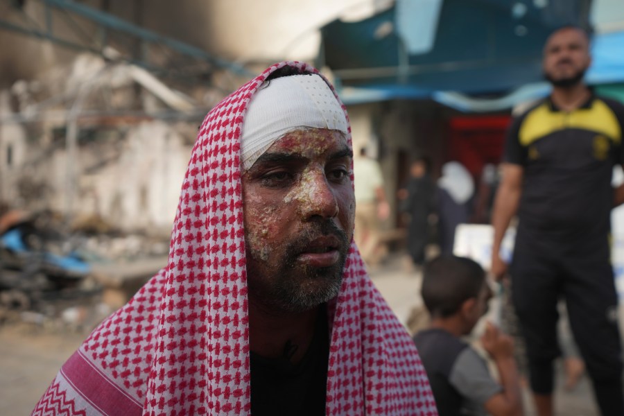 Ahmad al-Dalu, suffering from burns, lost his son, Shaban, in a fire after an Israeli strike hit a tent area in the courtyard of Al Aqsa Martyrs hospital in Deir al-Balah, Gaza Strip, at the site on Wednesday, Oct. 16, 2024. (AP Photo/Abdel Kareem Hana)